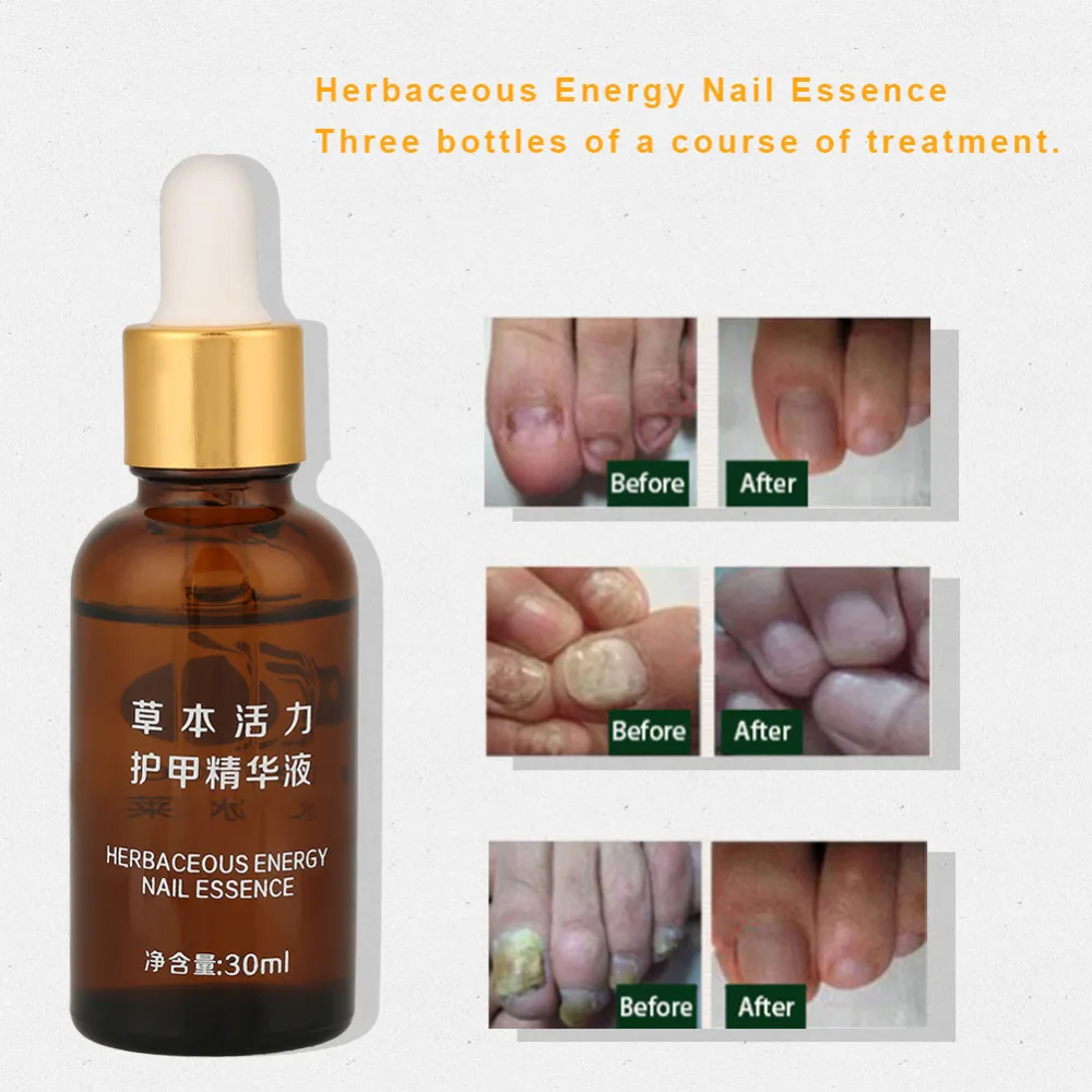 Professional Nail Treatment Herbaceous Energy Nail Essence Nail Treatment Oil Armor Sterilization Foot Nail Gel Care Remove Tool
Professional Nail Treatment Herbaceous Energy Nail Essence Nail Treatment Oil Armor Sterilization Foot Nail Gel Care Remove Tool
