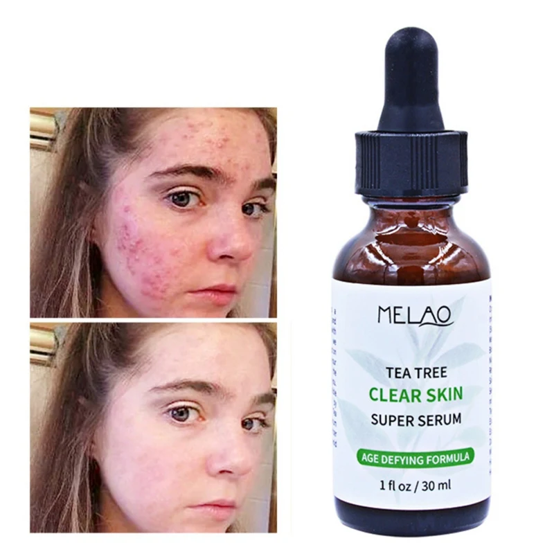 Tea Tree Essential Liquid Moisturizing Oil-Control Smooth Scars Acne Marks Face Serum 2019
Tea Tree Essential Liquid Moisturizing Oil-Control Smooth Scars Acne Marks Face Serum 2019
