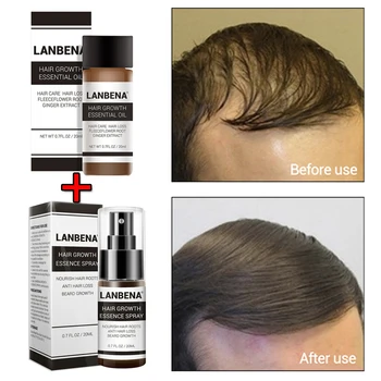Drop Ship Fast Powerful Hair Growth Essence+Spray 2PCS Preventing Baldness Consolidating Anti Hair Loss Nourish Roots Hair Care
Drop Ship Fast Powerful Hair Growth Essence+Spray 2PCS Preventing Baldness Consolidating Anti Hair Loss Nourish Roots Hair Care