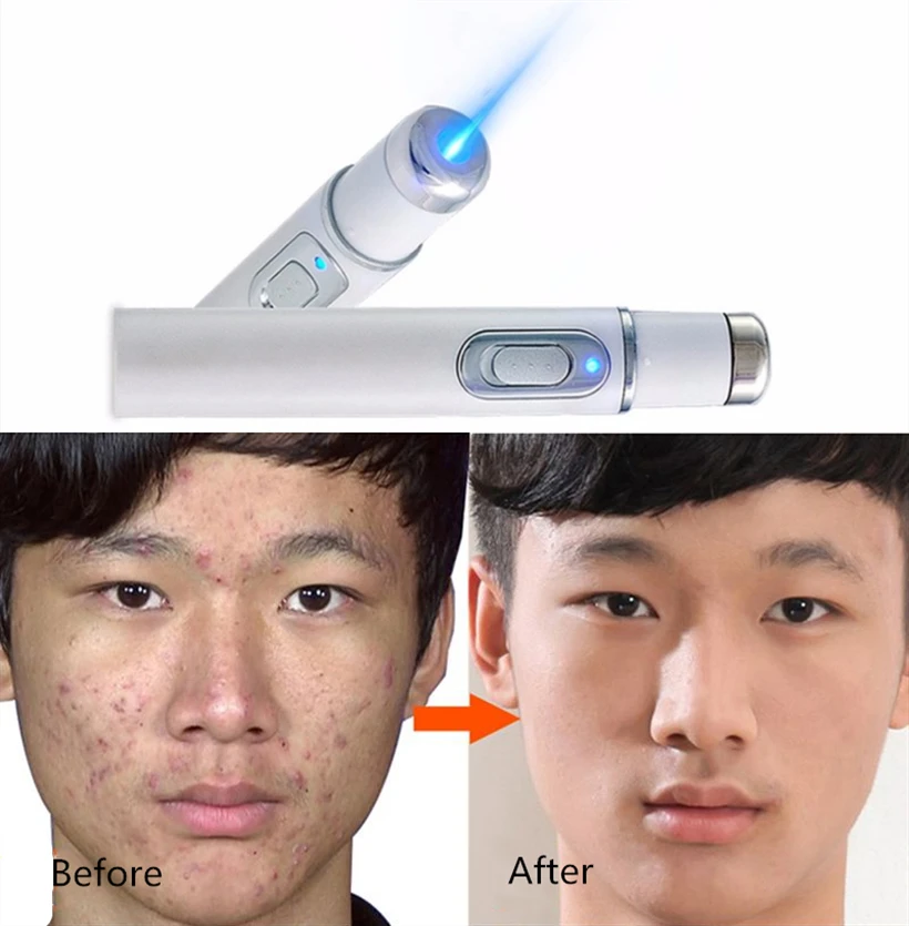 Blue Light Therapy Acne Laser Pen Portable Wrinkle Removal Machine Durable Soft Scar Removal Device Therapy Pen Face Skin Care
Blue Light Therapy Acne Laser Pen Portable Wrinkle Removal Machine Durable Soft Scar Removal Device Therapy Pen Face Skin Care