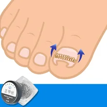 12 pcs Incarniti Chiodo della Punta di Correzione Filo Fixer Pedicure Paronychia Recuperare Le Unghie Dei Piedi Corrector Cura di Piede Strumento(China)