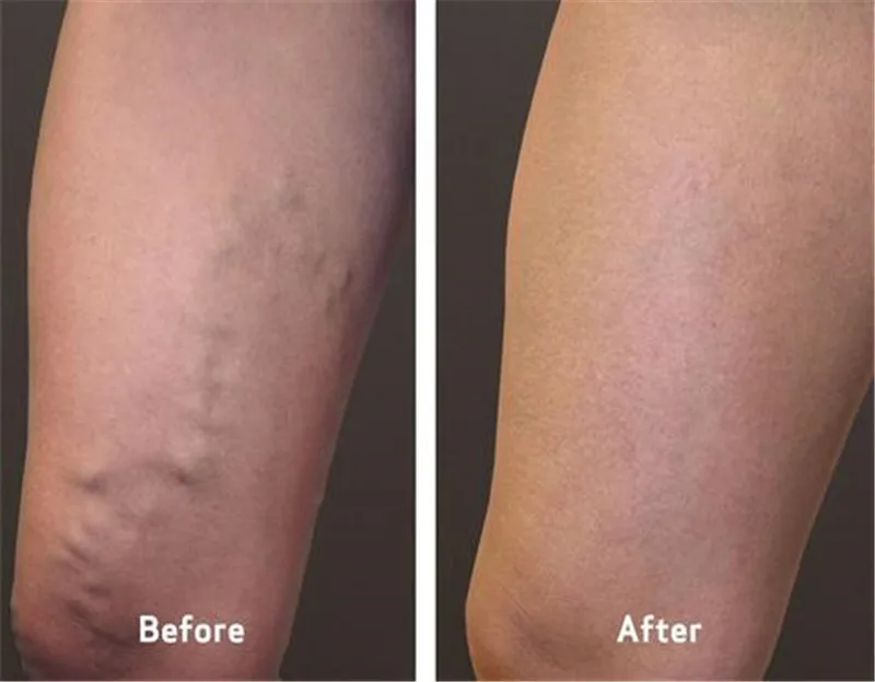 vca-before-and-after-varicose-veins-symptoms-home_1_large