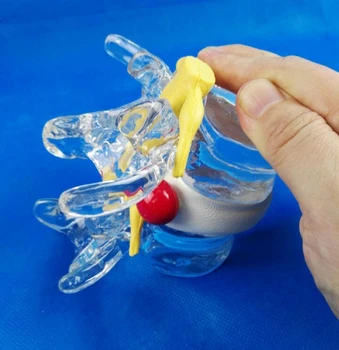 Vertebral Spinal Cord Compression Demo Model Human Medical Teaching Aids Lumbar Vertebrae Skeleton Degenerative Disc Herniation
Vertebral Spinal Cord Compression Demo Model Human Medical Teaching Aids Lumbar Vertebrae Skeleton Degenerative Disc Herniation