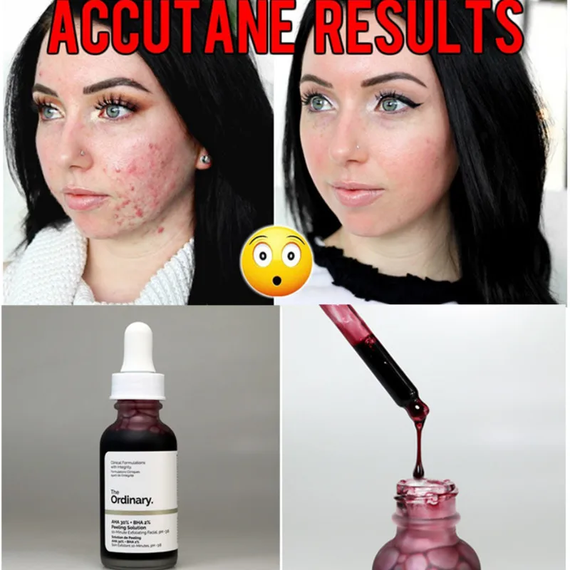 30ml 10mins Exfoliating Mask Facial Serum The Ordinary AHA 30% + BHA 2% Peeling Solution Remove Acne Scars Whitening Skin Care
30ml 10mins Exfoliating Mask Facial Serum The Ordinary AHA 30% + BHA 2% Peeling Solution Remove Acne Scars Whitening Skin Care