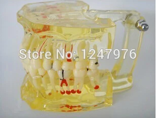 Pathological model of teeth with pathological model with planting nail impacted tooth
Pathological model of teeth with pathological model with planting nail impacted tooth