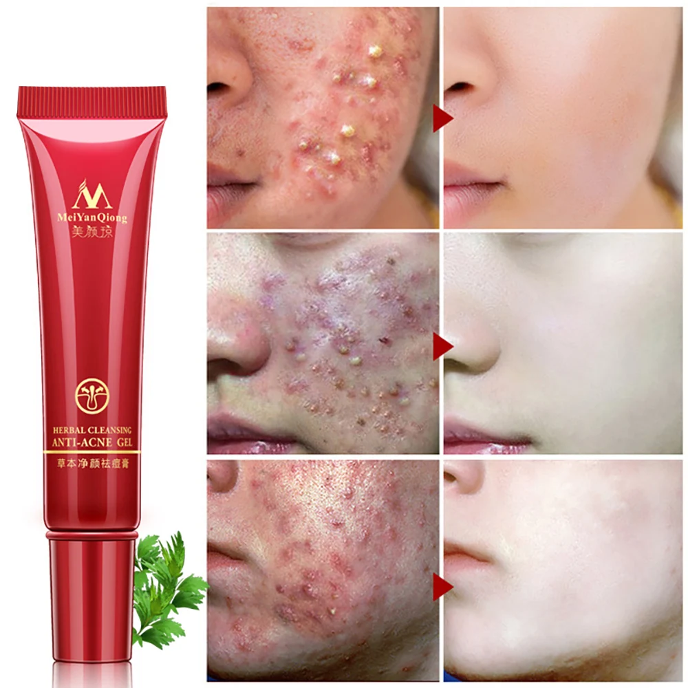 Meiyanqiong face anti acne removal cream skin repair Herbal cleansing for oily skin anti acne spots treatment cream MY005
Meiyanqiong face anti acne removal cream skin repair Herbal cleansing for oily skin anti acne spots treatment cream MY005