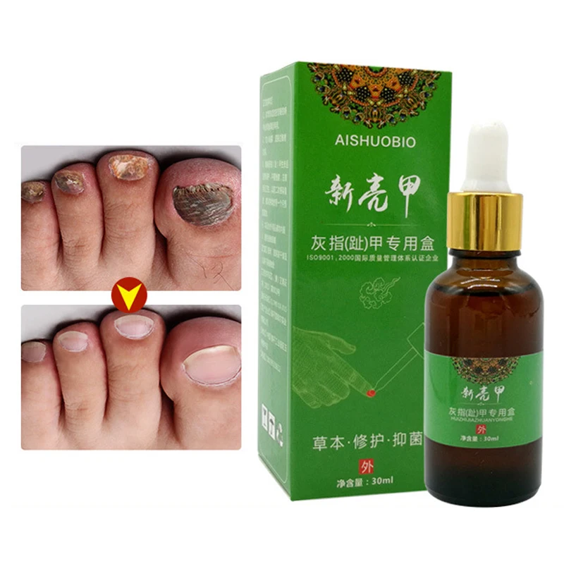 Onychomycosis Fungal treatment Nail Treatment Feet Care Essence oil Nail and Foot Whitening Toe Nail Fungus Removal Gel 30ml
Onychomycosis Fungal treatment Nail Treatment Feet Care Essence oil Nail and Foot Whitening Toe Nail Fungus Removal Gel 30ml