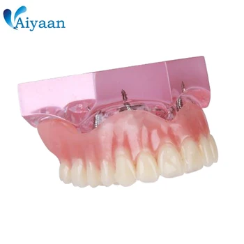 Dental Overdenture Teeth Model Removable Interior Mandibular Upper Teeth Model Mandibular with Implant for Tooth Teaching Study
Dental Overdenture Teeth Model Removable Interior Mandibular Upper Teeth Model Mandibular with Implant for Tooth Teaching Study
