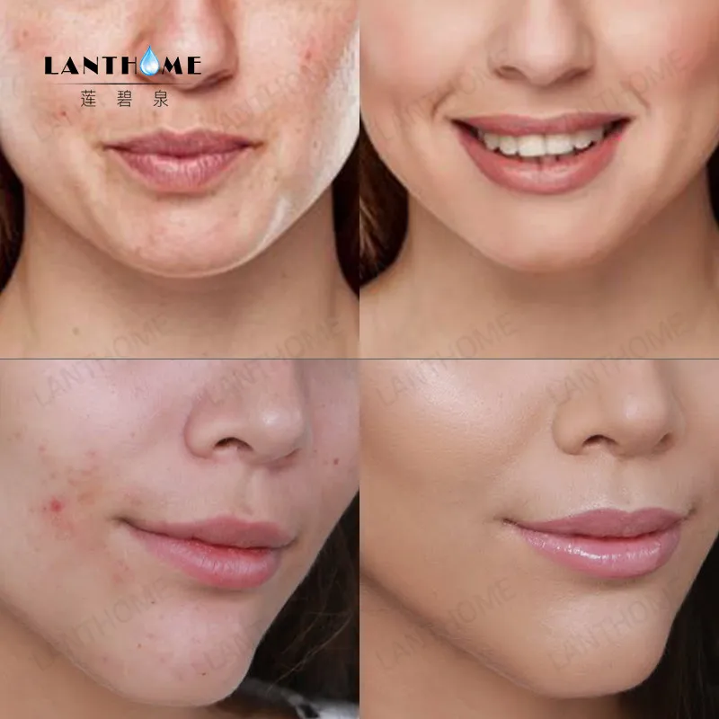 pearl acne cream