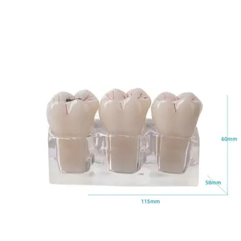 Dental model four times caries evolution model tooth decay demonstration doctor-patient communication caries development patholo
Dental model four times caries evolution model tooth decay demonstration doctor-patient communication caries development patholo