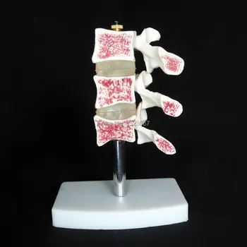 Human Osteoporosis Anatomical Vertebrae Model Medical Skeleton Anatomy Vertebrae Deluxe Osteoporosis Model
Human Osteoporosis Anatomical Vertebrae Model Medical Skeleton Anatomy Vertebrae Deluxe Osteoporosis Model