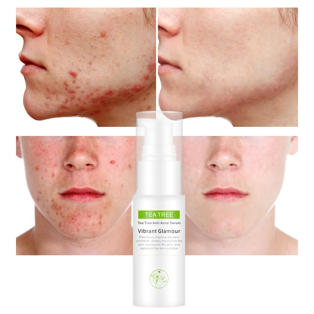 VIBRANT GLAMOUR Tea Tree Anti-Acne Serum Water Oil-control Acne Toner Scar Cream Treatment Youth Acne For Face Skin Care Product
VIBRANT GLAMOUR Tea Tree Anti-Acne Serum Water Oil-control Acne Toner Scar Cream Treatment Youth Acne For Face Skin Care Product