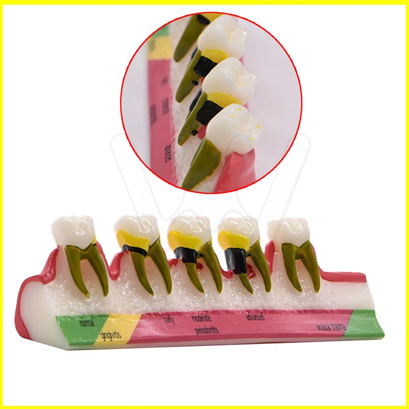 Dental-Caries-Demonstration-Model-Teeth-Teaching-Patient-Disease