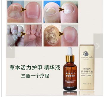 Nail Oil Gel Fungus Onychomycosis Removal Treatment Toe Repair Essence Liquid JUP
Nail Oil Gel Fungus Onychomycosis Removal Treatment Toe Repair Essence Liquid JUP