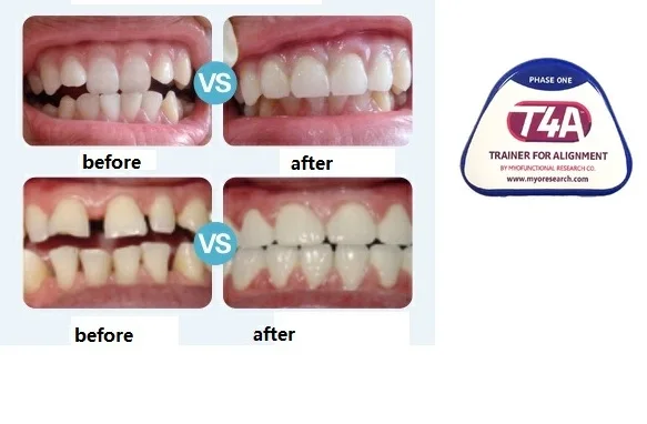 1 шт. Ортодонтические фиксаторы для отбеливания зубов | Красота и здоровье