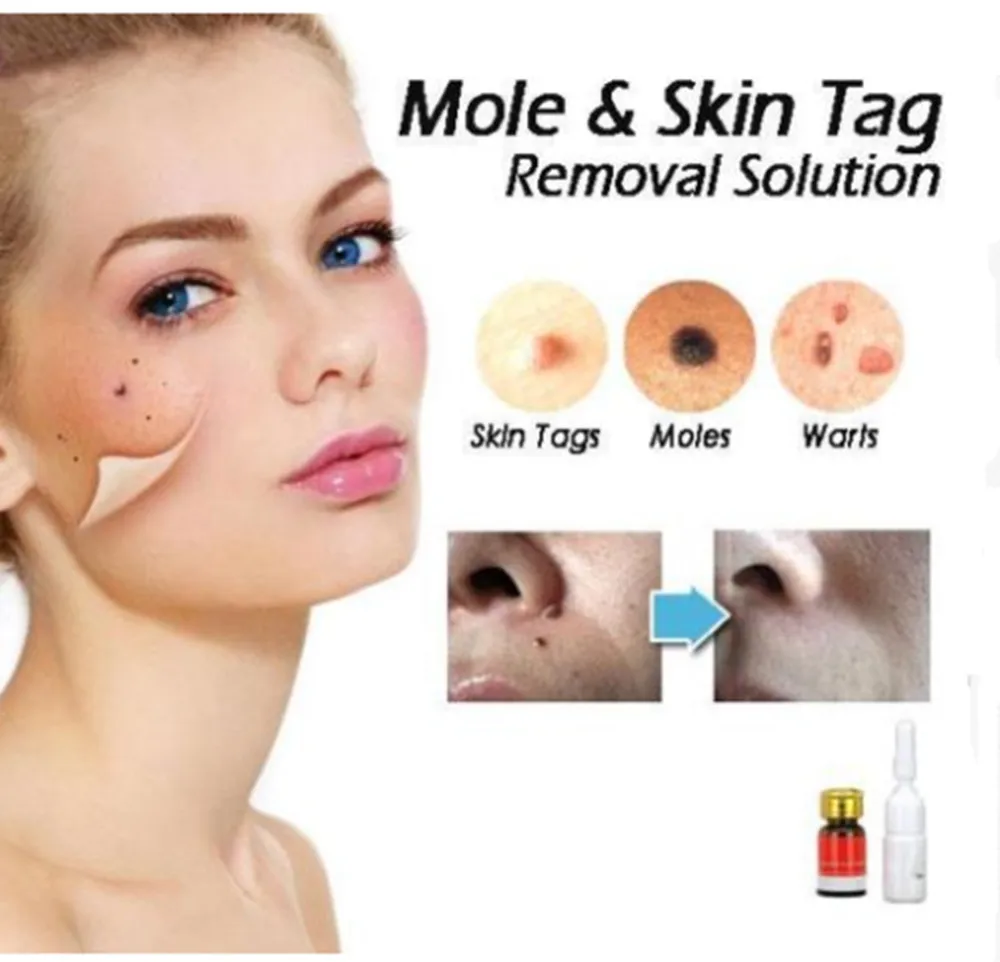 Profession Mole & Skin Tag Removal Solution Painless Easy To Apply Skin Care Tools Goft For Birthday Festival
Profession Mole & Skin Tag Removal Solution Painless Easy To Apply Skin Care Tools Goft For Birthday Festival