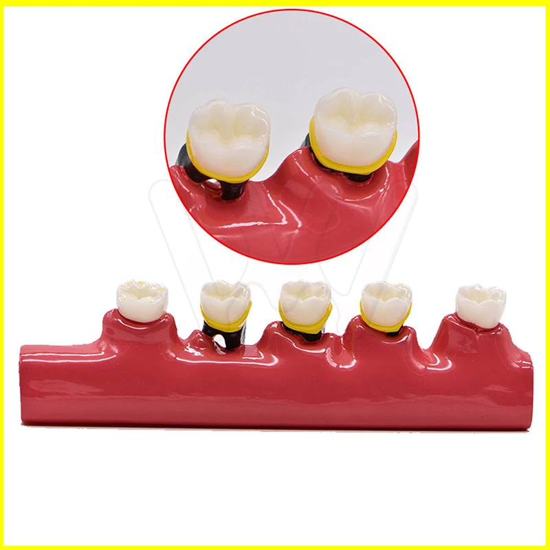 Dental-Caries-Demonstration-Model-Teeth-Teaching-Patient-Disease-_57