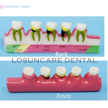 1 PC Oral periodontal disease classification model gingivitis degree chronic periodontitis dentist communication
1 PC Oral periodontal disease classification model gingivitis degree chronic periodontitis dentist communication