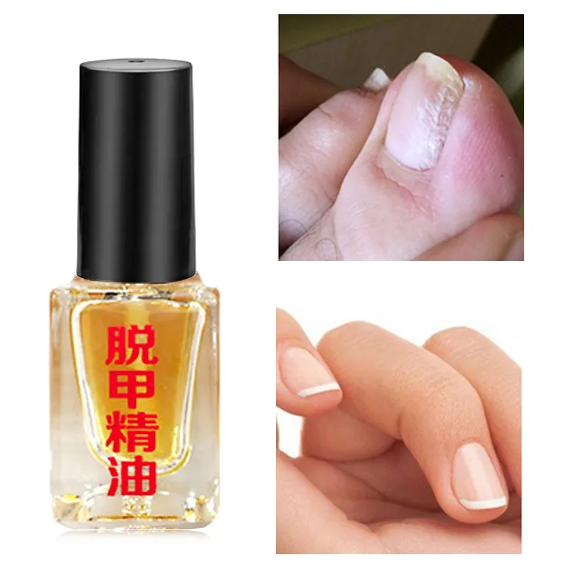 2019Nail FungalRemoval Bactericidal Onychomycosis Paronychia Ance Oil Multi-Use Top & Base Coat Nail Infection Toe
2019Nail FungalRemoval Bactericidal Onychomycosis Paronychia Ance Oil Multi-Use Top & Base Coat Nail Infection Toe