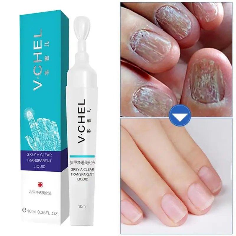 10ML Fungal Nail Treatment Pen Effective Onychomycosis Paronychia Fungus Infection Repair Solution Gel Fingernails Toenails Care
10ML Fungal Nail Treatment Pen Effective Onychomycosis Paronychia Fungus Infection Repair Solution Gel Fingernails Toenails Care