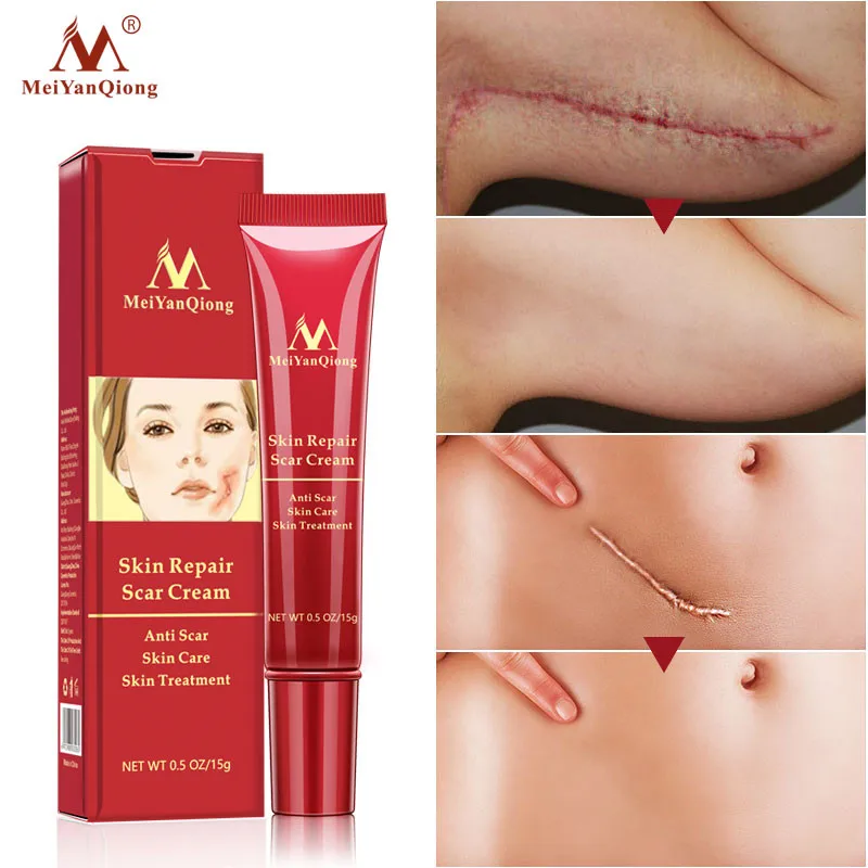 MeiYanQiong Acne Scar Removal Cream Skin Repair Face Cream Acne Spots Acne Treatment Anti Scar Stretch Marks Body Skin Cream
MeiYanQiong Acne Scar Removal Cream Skin Repair Face Cream Acne Spots Acne Treatment Anti Scar Stretch Marks Body Skin Cream