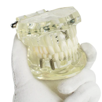 Dental Implant Disease Teeth Model Tooth For Medical Science Dental Disease Teaching Dental Restoration Model
Dental Implant Disease Teeth Model Tooth For Medical Science Dental Disease Teaching Dental Restoration Model