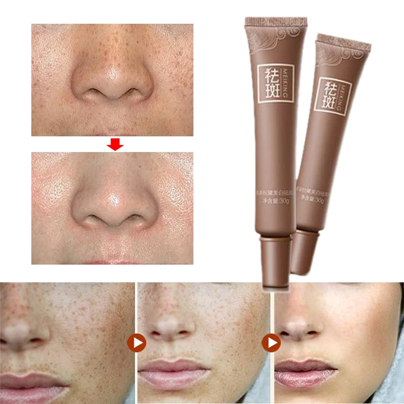 Hot Sale Skin Care Age Spot Melasma Remove Freckle Face Cream Whitening Lightening
Hot Sale Skin Care Age Spot Melasma Remove Freckle Face Cream Whitening Lightening