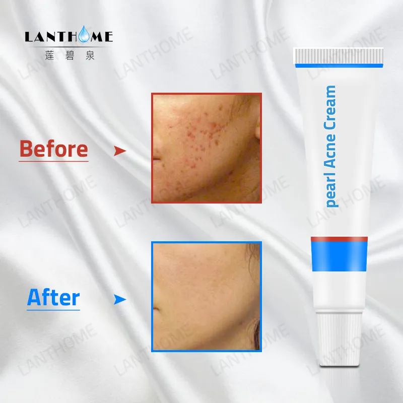pearl acne cream