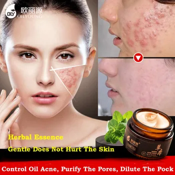 Herbal Acne Cream Anti Pimple Spot Acne Scars Blackhead Removal Cream Whitening Beauty Skin Face Care Creams Acne Treament
Herbal Acne Cream Anti Pimple Spot Acne Scars Blackhead Removal Cream Whitening Beauty Skin Face Care Creams Acne Treament