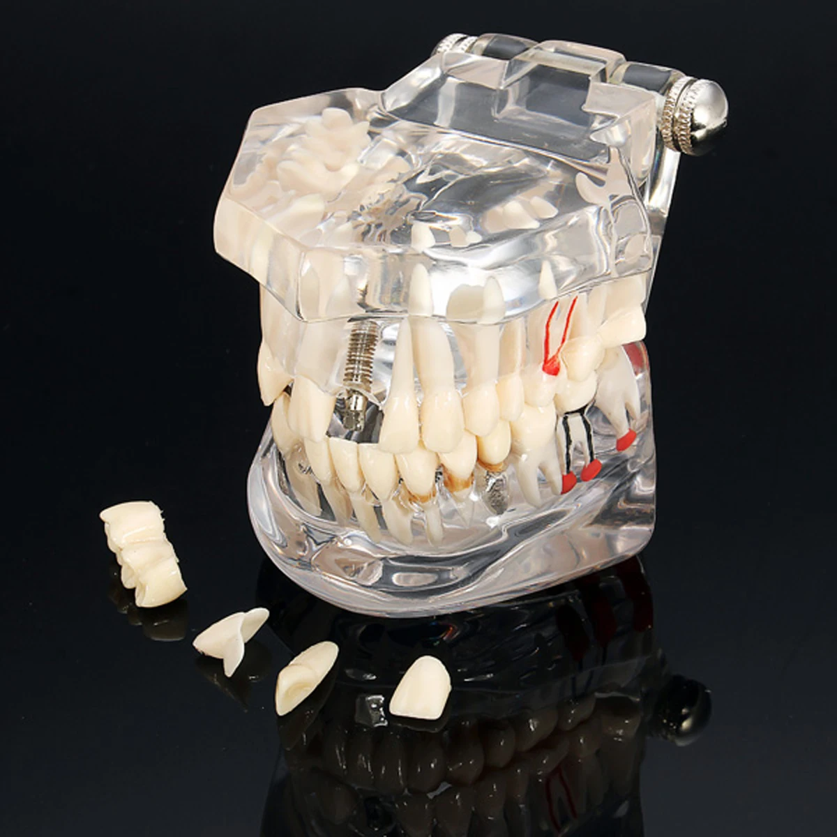1pc Dental Implant Disease Teeth Model With Restoration Bridge Tooth Dentist For Medical Science Dental Disease Teaching Study
1pc Dental Implant Disease Teeth Model With Restoration Bridge Tooth Dentist For Medical Science Dental Disease Teaching Study
