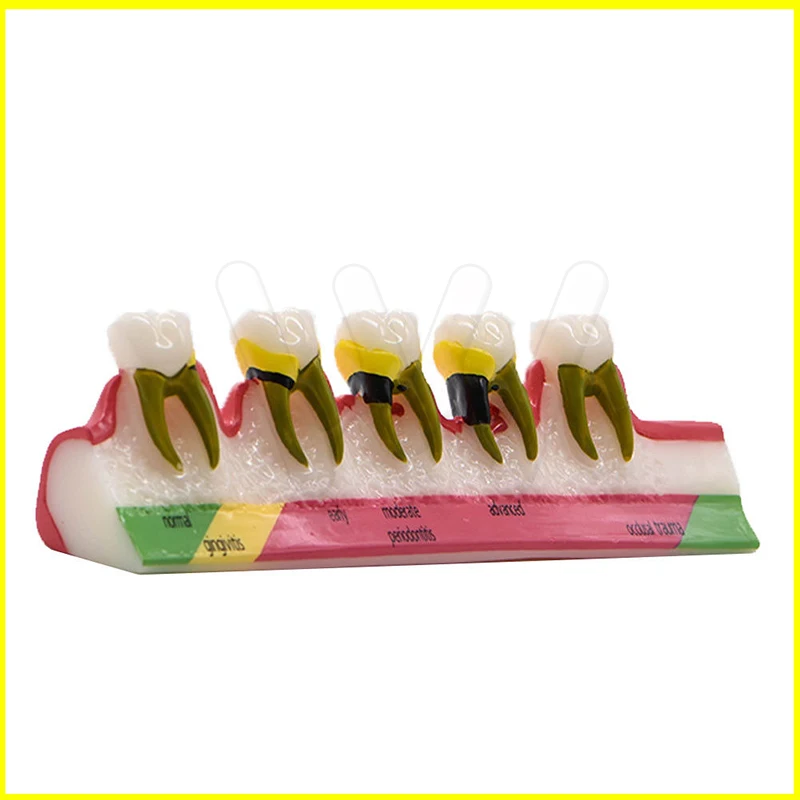 Dental-Caries-Demonstration-Model-Teeth-Teaching-Patient-Disease-_57 (3)
