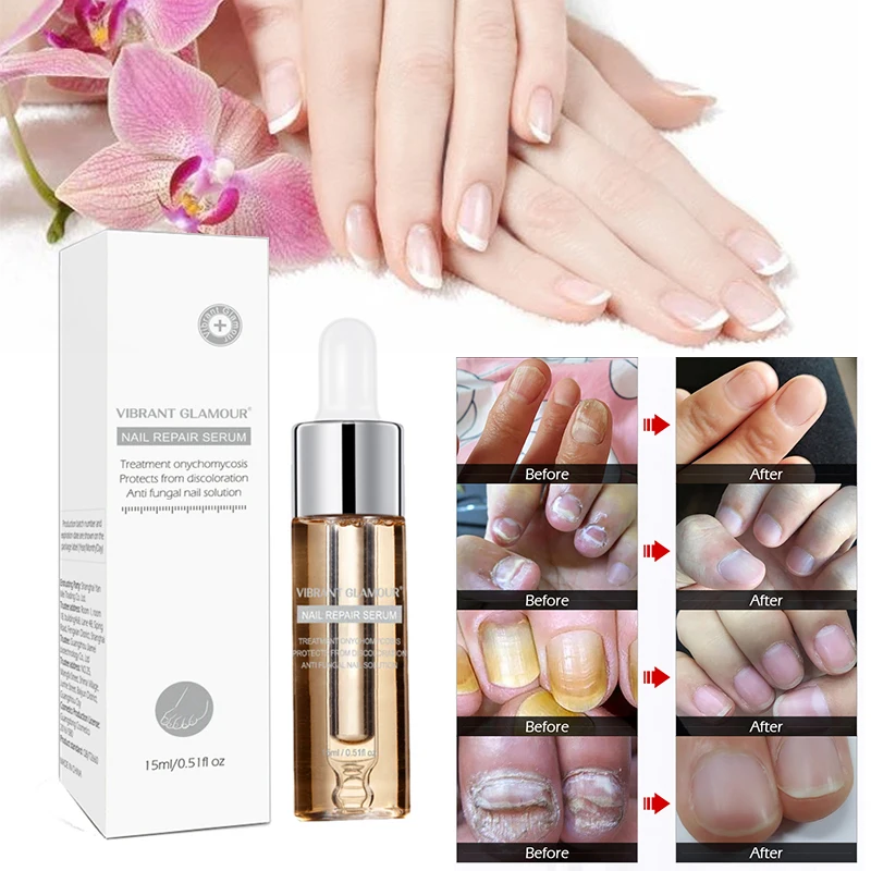 15ml Fungal Nail Treatment Essence Onychomycosis Paronychia Anti Fungal Nail Infection Plant Care Essence Nail Repair Care TSLM2
15ml Fungal Nail Treatment Essence Onychomycosis Paronychia Anti Fungal Nail Infection Plant Care Essence Nail Repair Care TSLM2
