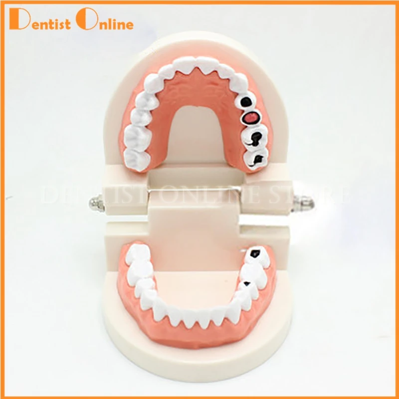 1PC Dental Implant Disease Teeth Model With Tooth Decay Oral Care Clean Tool For Medical Science Dentist Disease Teaching Study
1PC Dental Implant Disease Teeth Model With Tooth Decay Oral Care Clean Tool For Medical Science Dentist Disease Teaching Study