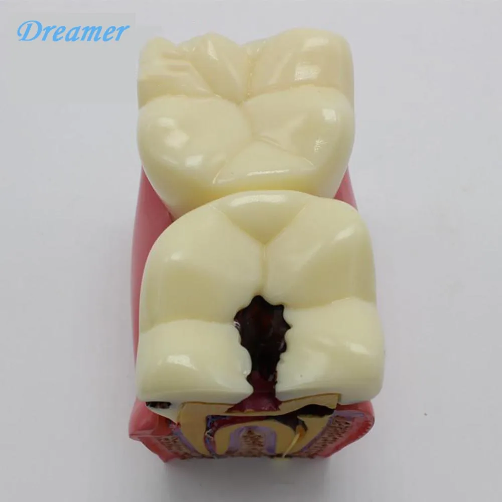 High Quality Oral Model 6 Times Dental Caries Comparison Model Dental Tooth Model
High Quality Oral Model 6 Times Dental Caries Comparison Model Dental Tooth Model
