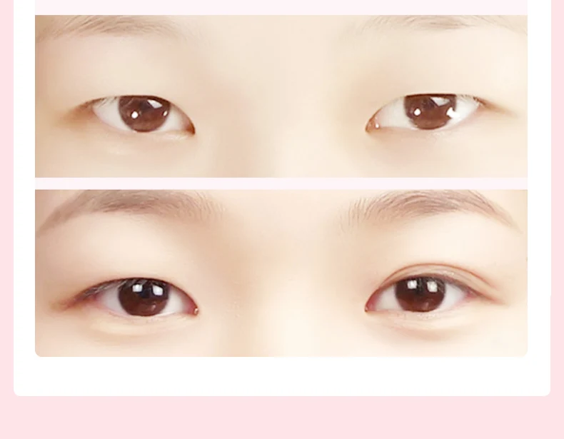 Pin on Eyelid Surgery