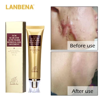 LANBENA Cream Acne Scar Removal creme Face Cream Skin Repair Spots Acne Treatment Blackhead Whitening Cream Stretch Marks 30ml
LANBENA Cream Acne Scar Removal creme Face Cream Skin Repair Spots Acne Treatment Blackhead Whitening Cream Stretch Marks 30ml