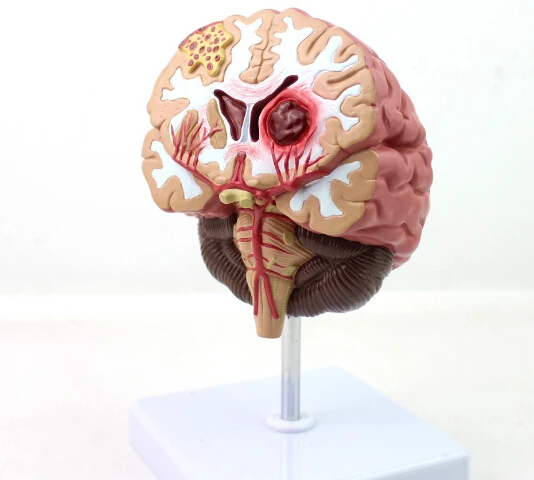 Фото Модель мозговых заболеваний человека анатомическая модель мозга нейрохирургии