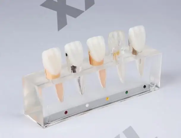 pathology Patient communication model Endodontic treatment Upper central incisor free shipping
pathology Patient communication model Endodontic treatment Upper central incisor free shipping