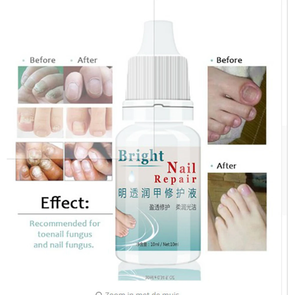 High Effective Fungal Nail Treatment Essence oil 10ml Nail and Foot Whitening finger Toe Nail Fungus Removal Feet Care Nail Gel
High Effective Fungal Nail Treatment Essence oil 10ml Nail and Foot Whitening finger Toe Nail Fungus Removal Feet Care Nail Gel