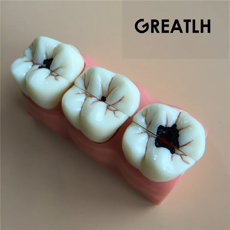 1 Piece 4:1 Size Dental Caries Removable Teeth Tooth Model Dentist Patient Communication Demonstrate Teeth Model
1 Piece 4:1 Size Dental Caries Removable Teeth Tooth Model Dentist Patient Communication Demonstrate Teeth Model