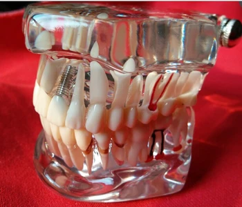 Teeth model dental activity pathological model removable dental teeth model dental tooth model
Teeth model dental activity pathological model removable dental teeth model dental tooth model