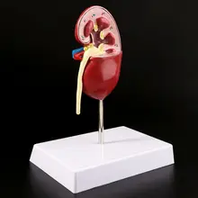 Model Stone Diseased Pathological Anatomical-Anatomy Human Kidney Life-Size Organ Teaching-Supplies