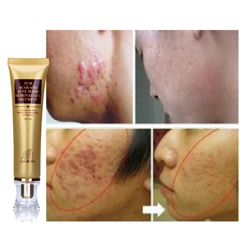 Herbal Scar Removal Cream for Ance Whitening Skin Striae and Acne Treatment Beauty and Health Anti Acne Wrinkle Cream for Face
Herbal Scar Removal Cream for Ance Whitening Skin Striae and Acne Treatment Beauty and Health Anti Acne Wrinkle Cream for Face