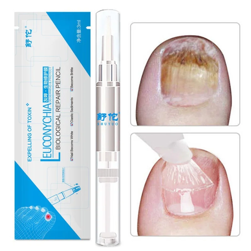 1x3ML Nail Treatment Pen Anti Fungus Nail Liquid Fungal Onychomycosis Paronychia Anti Fungal Nail Infection Chinese Herbal TSLM1
1x3ML Nail Treatment Pen Anti Fungus Nail Liquid Fungal Onychomycosis Paronychia Anti Fungal Nail Infection Chinese Herbal TSLM1