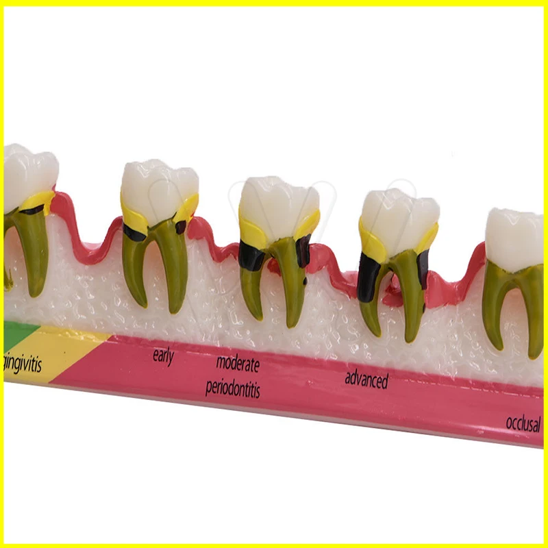 Dental-Caries-Demonstration-Model-Teeth-Teaching-Patient-Disease-_57 (1)