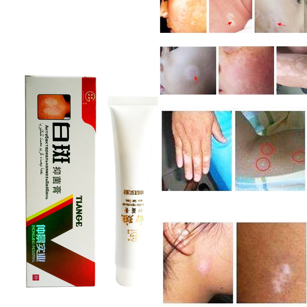 Chinese Medical White Spot Disease Cream Pigment Melanin Promoting Liniment Skin Vitiligo Leukoplakia Disease Treatment 30g D184
Chinese Medical White Spot Disease Cream Pigment Melanin Promoting Liniment Skin Vitiligo Leukoplakia Disease Treatment 30g D184