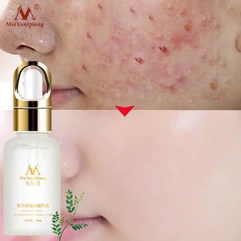 

MeiYanQiong Centella asiatica acne extract removes acne scars, controls oil, and improves facial whitening skin 10ml