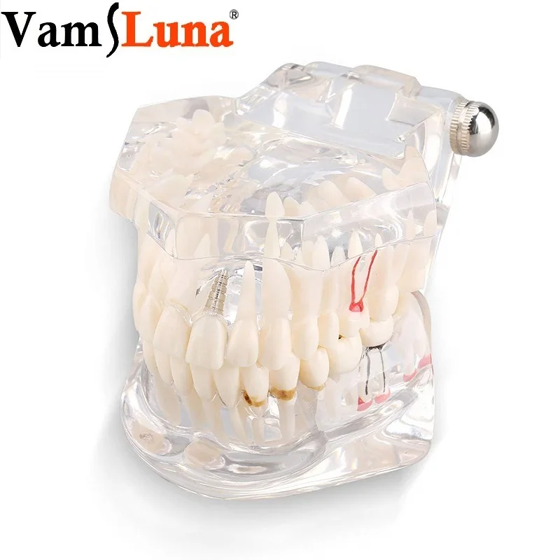 Dental Tooth Model Transparent Adult Pathologies Study Teaching Teeth Implant Disease with Removable Tooth Restoration Bridge
Dental Tooth Model Transparent Adult Pathologies Study Teaching Teeth Implant Disease with Removable Tooth Restoration Bridge