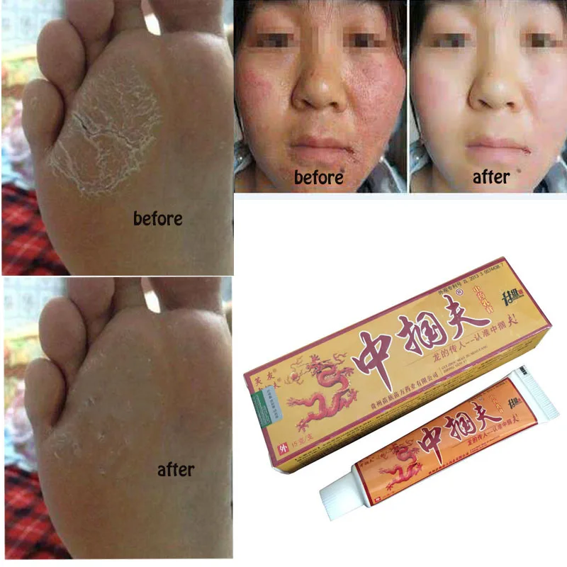 1PC Psorias Eczema Pruritus Psoriasis Skin Problems China Creams Psoriasis Creams Facial Cleansing With Retail Box
1PC Psorias Eczema Pruritus Psoriasis Skin Problems China Creams Psoriasis Creams Facial Cleansing With Retail Box