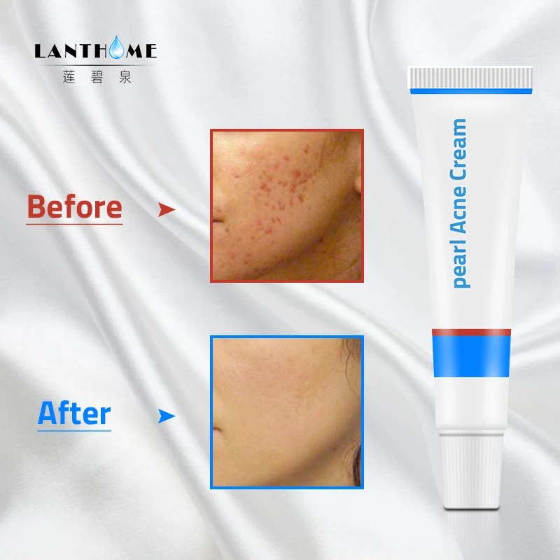 Pearl Acne Treatment Blackhead Remova Anti Mite Acne Rosacea Cream Oil Control Shrink Pores Acne Scar Remove Face Care Whitening
Pearl Acne Treatment Blackhead Remova Anti Mite Acne Rosacea Cream Oil Control Shrink Pores Acne Scar Remove Face Care Whitening